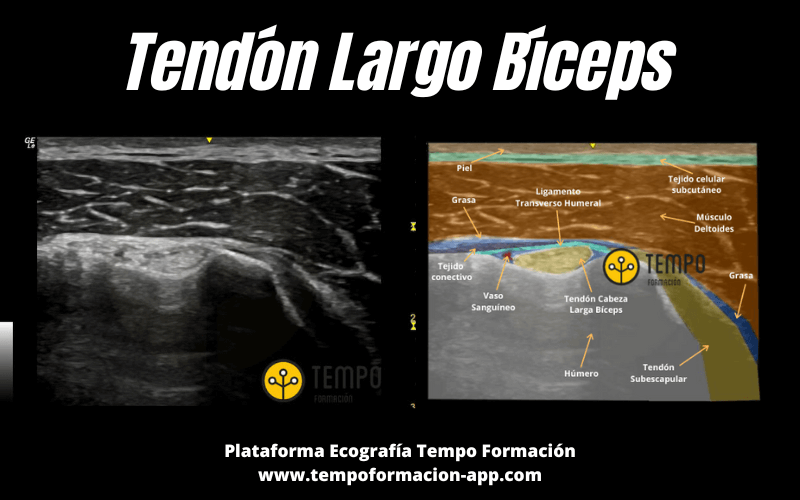 Tendón Largo Bíceps Ecografía Aprende a valorarlo Tempo Formación